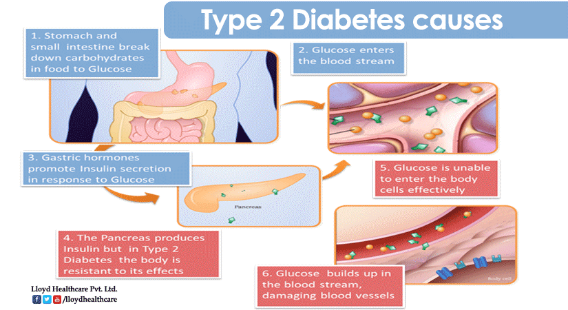 Type 2 Diabetes